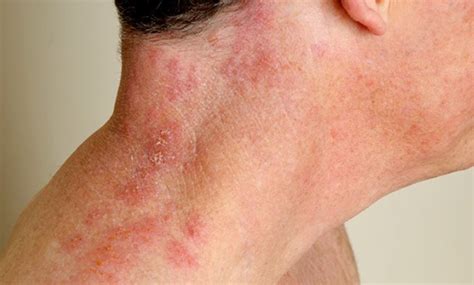Shingles On Scalp Symptoms Pictures Contagious No Rash With