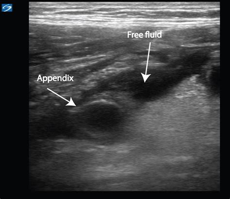 Appendicitis Critical Care Sonography