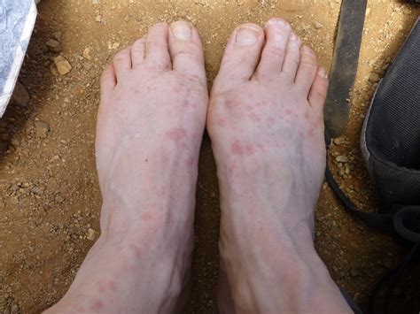 Prickly Heat Rash On Top Of Feet Foot Rash Causes Symptoms