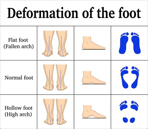 How To Fix Flat Feet