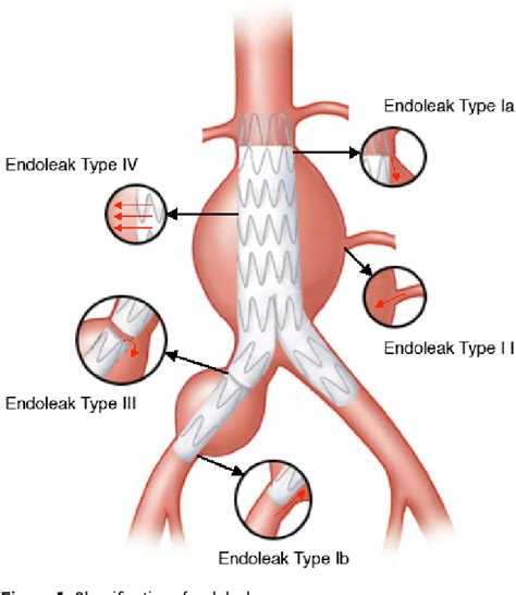 Figure 1 From Endoleaks After Endovascular Abdominal Aortic Aneurysm