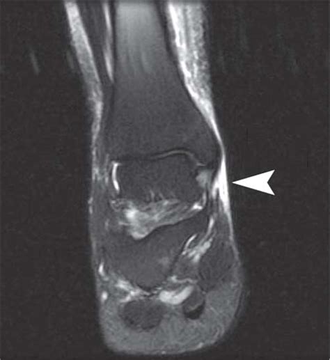 Grade 2 Ligament Tear Ankle Ankle Sprains Grades Ankle Ligament