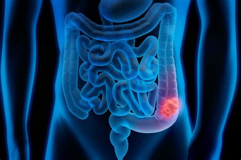 It usually begins as small, noncancerous (benign) clumps of cells called polyps that form on the inside of the colon. Top Myths About Colon Cancer, Debunked | Roswell Park ...