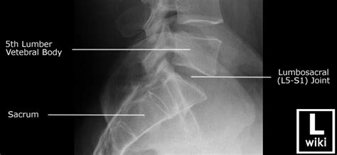Lumbar Spine Radiographic Anatomy Wikiradiography
