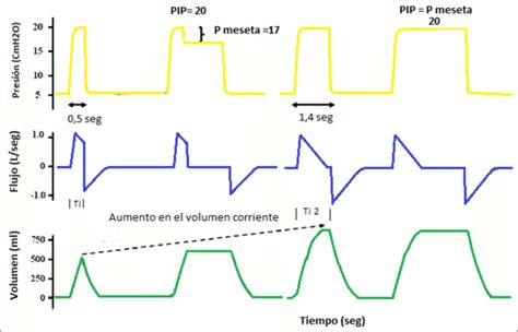 Ventilacion Mecanica Presion Positiva