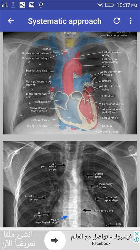 All our software downloads are tested spyware & adware free 100%. Chest X-Ray Interpretation for Android - APK Download