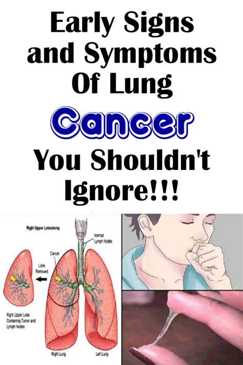 Early Signs And Symptoms Of Lung Cancer You