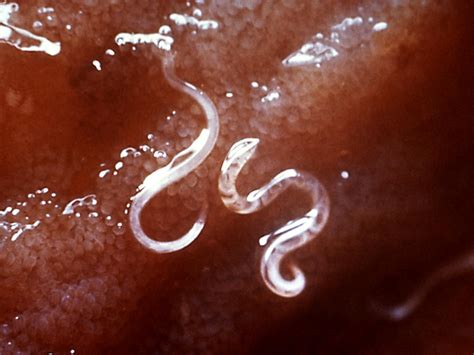 A Canadian Couple Got Infected By Hookworm While Walking On A Beach