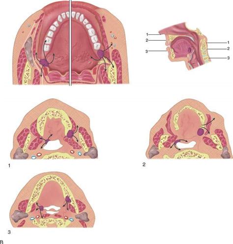 Oropharynx Malignant Tumors Radiology Key