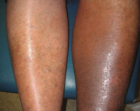 brown and black scaly patches on the lower leg—quiz cardiology jama dermatology jama network