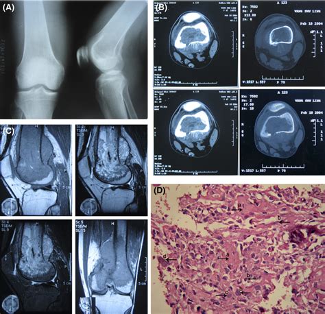 Imaging And Pathology Diagnosis Of Osteosarcoma A X Ray The