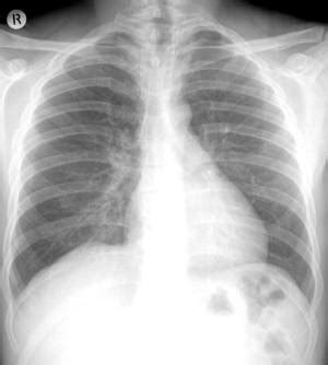 It may or may not also affect the pleura lining the diaphragm (the thin breathing muscle below the lungs), the mediastinum (the space between the. Mesothelioma Deaths Expected to Peak in 2010 ...