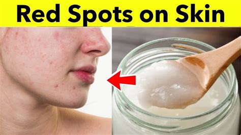 How To Remove Red Spots On Face Natural Home Remedies To Get Rid Of