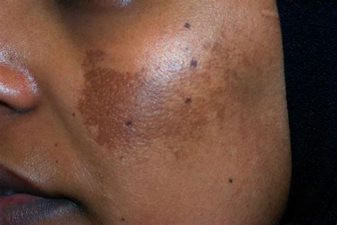 2 Common Pigmentation Issues For Poc — Theoilyesti