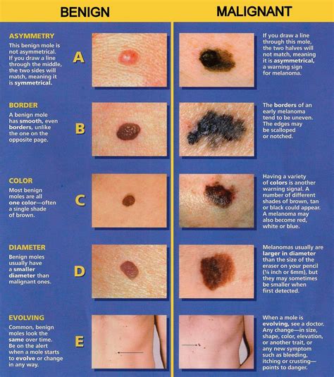 Melanoma How Do You Know If A Mole Is Dangerous Carenity