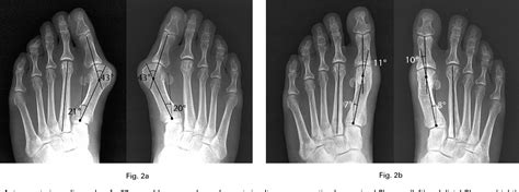 Figure 2 From A Comparison Of Proximal And Distal Chevron Osteotomy