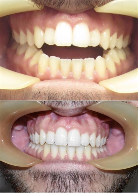 Before And After Open Bite Case Rinvisalign