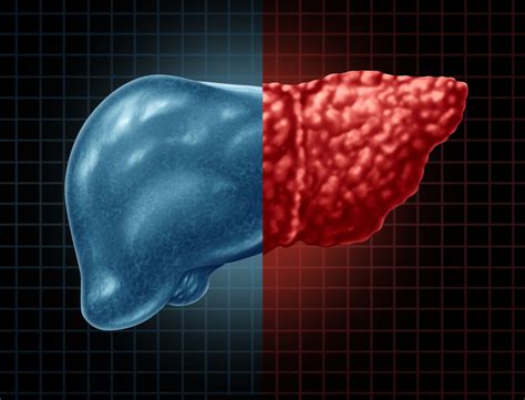 Non Alcoholic Fatty Liver Know The Symptoms Of This Reversible Disease