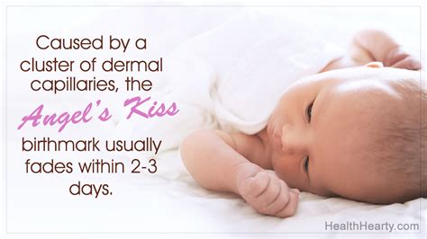 Emphasizing On The Meaning And Causes Of Angels Kiss Birthmark