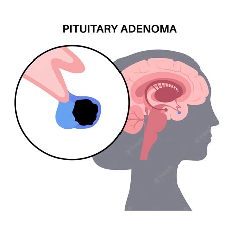Premium Vector Pituitary Adenoma Concept Tumor In The Human Brain