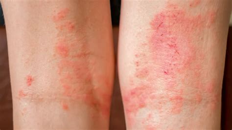 Eczeme Dermatita Amed Md