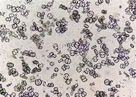 Urinálise Microscópica Mostrando Monohidrato De Oxalato De Cálcio