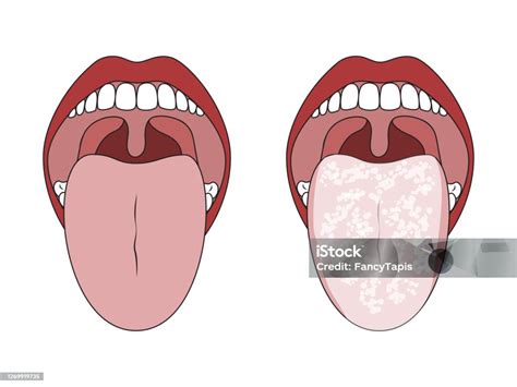 Clean Healthy Tongue And White Coated Tongue Stock Illustration