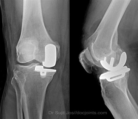 Unicondylar Knee Replacement Docjointsdr Sujit Josjoint Surgeon