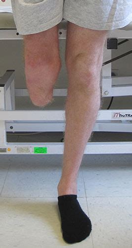 Lengthening Below Knee Amputation To Enhance Prosthetic Wear