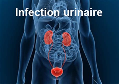 Infection Urinaire Chez L Homme Sympt Mes Traitement D Finition Docteurclic Com