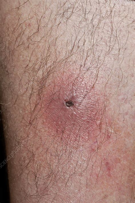 Infected Spider Bite Stock Image C0401049 Science Photo Library