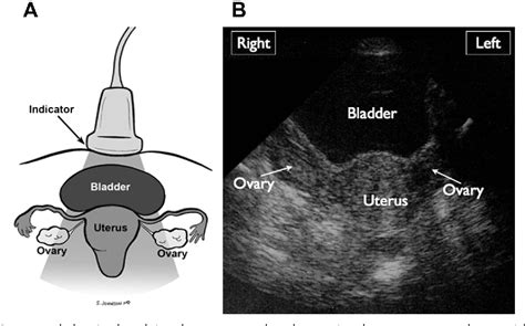 Figure From Bedside Ultrasonography For Obstetric And Gynecologic