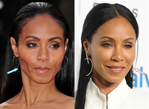 Jada Pinkett Smith Botox Before And After Photo Compare In 2021