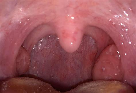 My Tonsils Hurt And I Took This Picture Raskmedical