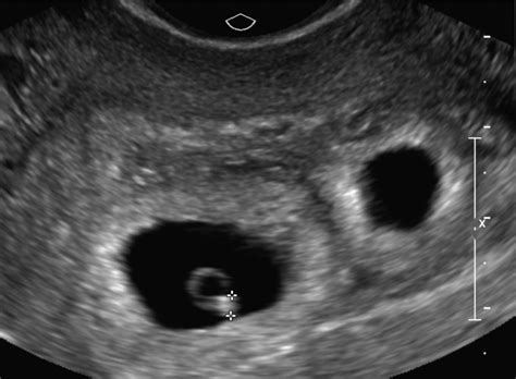 6 Weeks 4 Days Pregnant Ultrasound