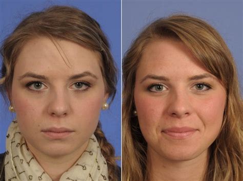 Ptosis Droopy Eyelid Surgery Before And After Pictures