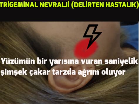 Trİgemİnal Nevraljİ Delİrten Hastalik Baş Ağrısı Nedenleri