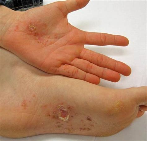 Dyshidrotic Eczema Pictures Information Variuos