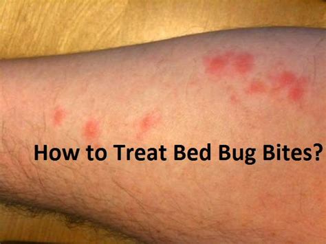 How To Treat Bed Bug Bites