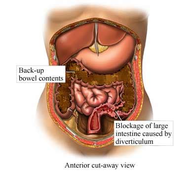 As these continue to build up, pressure symptoms of a bowel obstruction can include bloating, cramping, nausea, and a swollen belly. Mechanical Bowel Obstruction - Western New York Urology ...