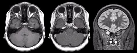 Optic Glioma