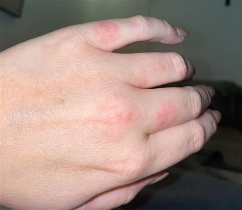 What Is This Rash On My Hands Raskdocs