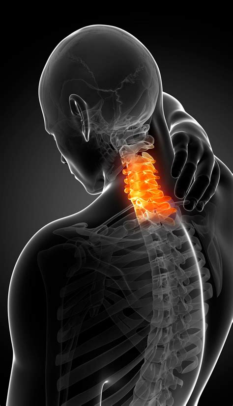 Pinched Nerve In Neck 7 Best Exercise