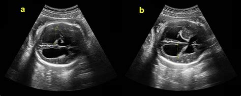 Abnormality In A Fetus On Ultrasound The Bmj