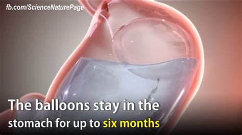 swallowable gastric balloon could help obese patients lose weight without surgery youtube