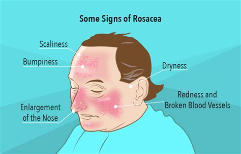 Find Relief For Skin Redness Rosacea My Doctor Online