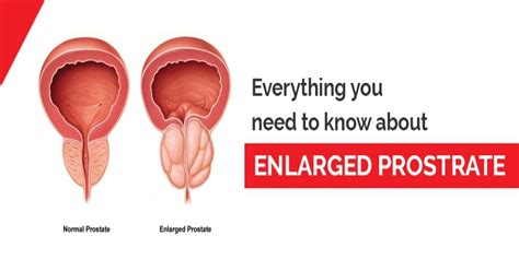 Everything You Need To Know About Enlarged Prostate Rg Hospitals