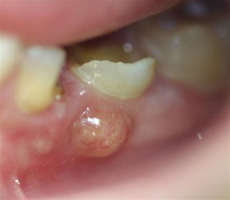 How To Drain A Gum Abscess At Home Without A Needle Youmemindbody