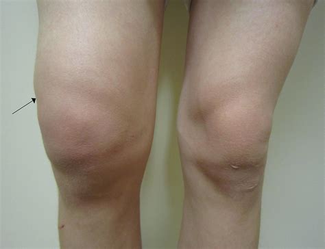 Swollen Knee Mexico Pdf Ppt Case Reports Symptoms Treatment