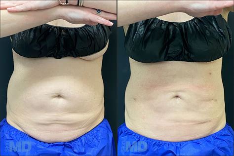 Liposuction Boston Skin Md Laser And Cosmetic Group